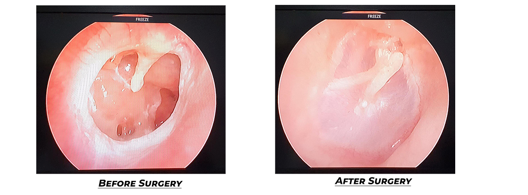 Eardrum perforation after surgery at Sri Onkar Eye & ENT Care Centre