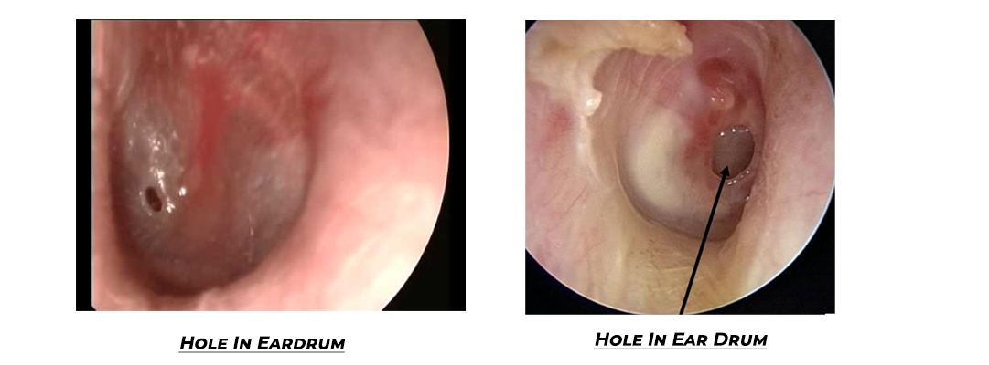 hole in eardrum | Sri Onkar Eye & ENT Care Centre