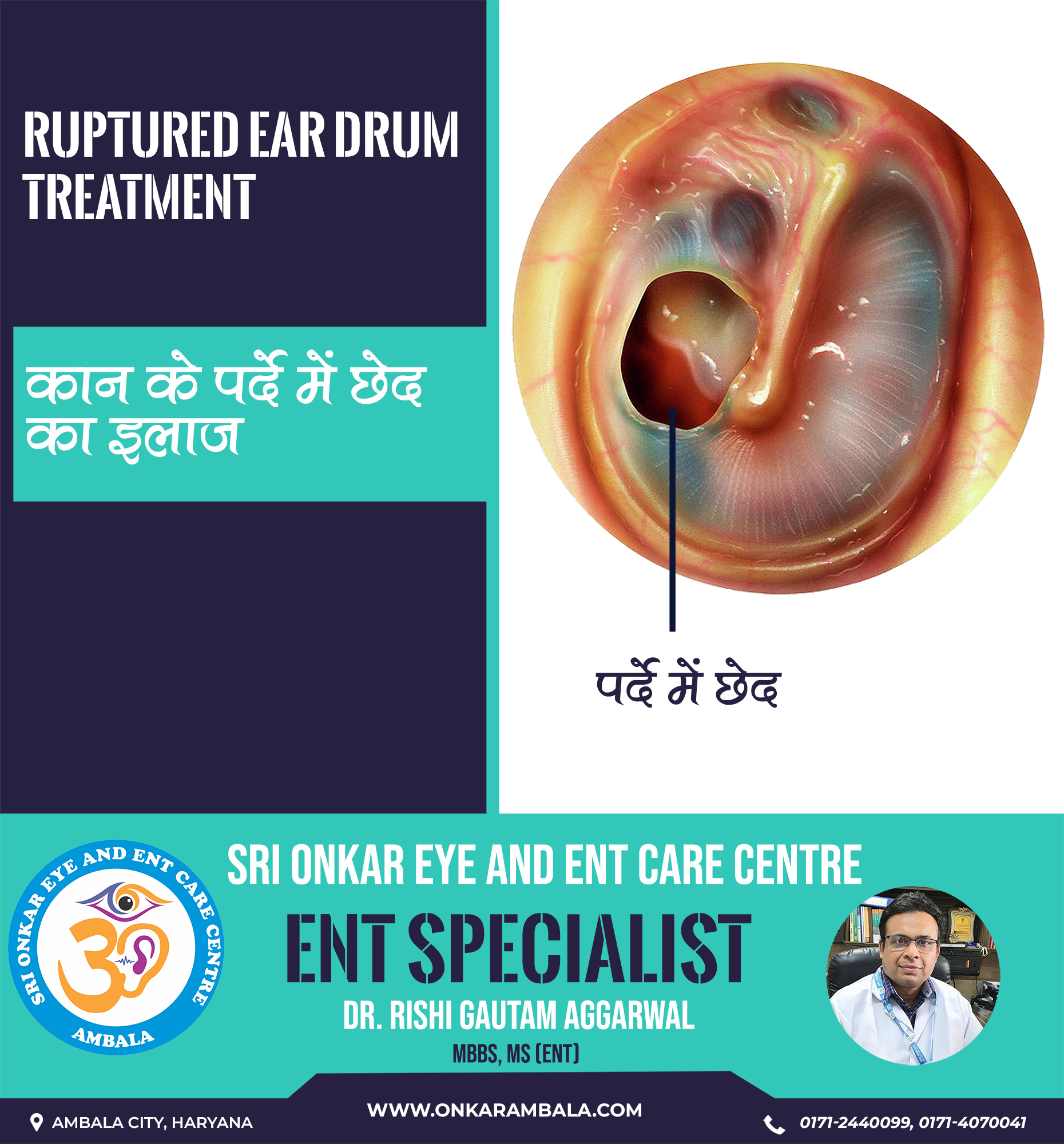 Ruptured Ear Drum | Sri Onkar Eye & ENT Care Centre