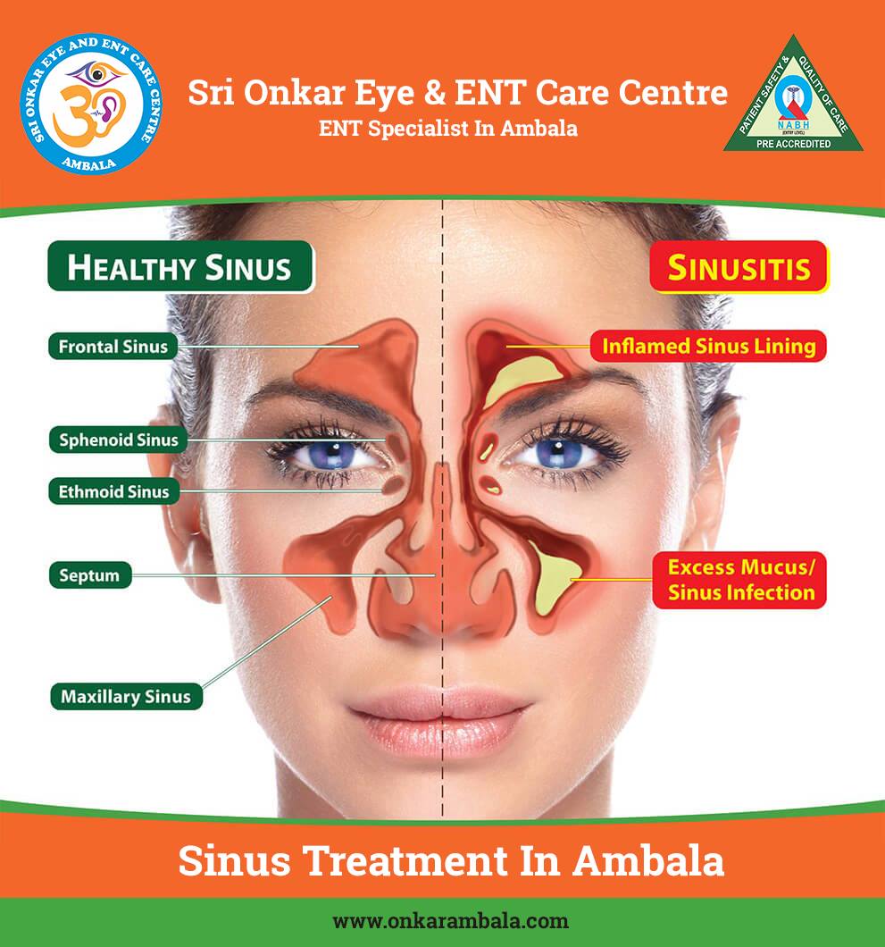 Sinus Treatment in Ambala | Sinus Illustration | Sri Onkar Eye & ENT Care Centre