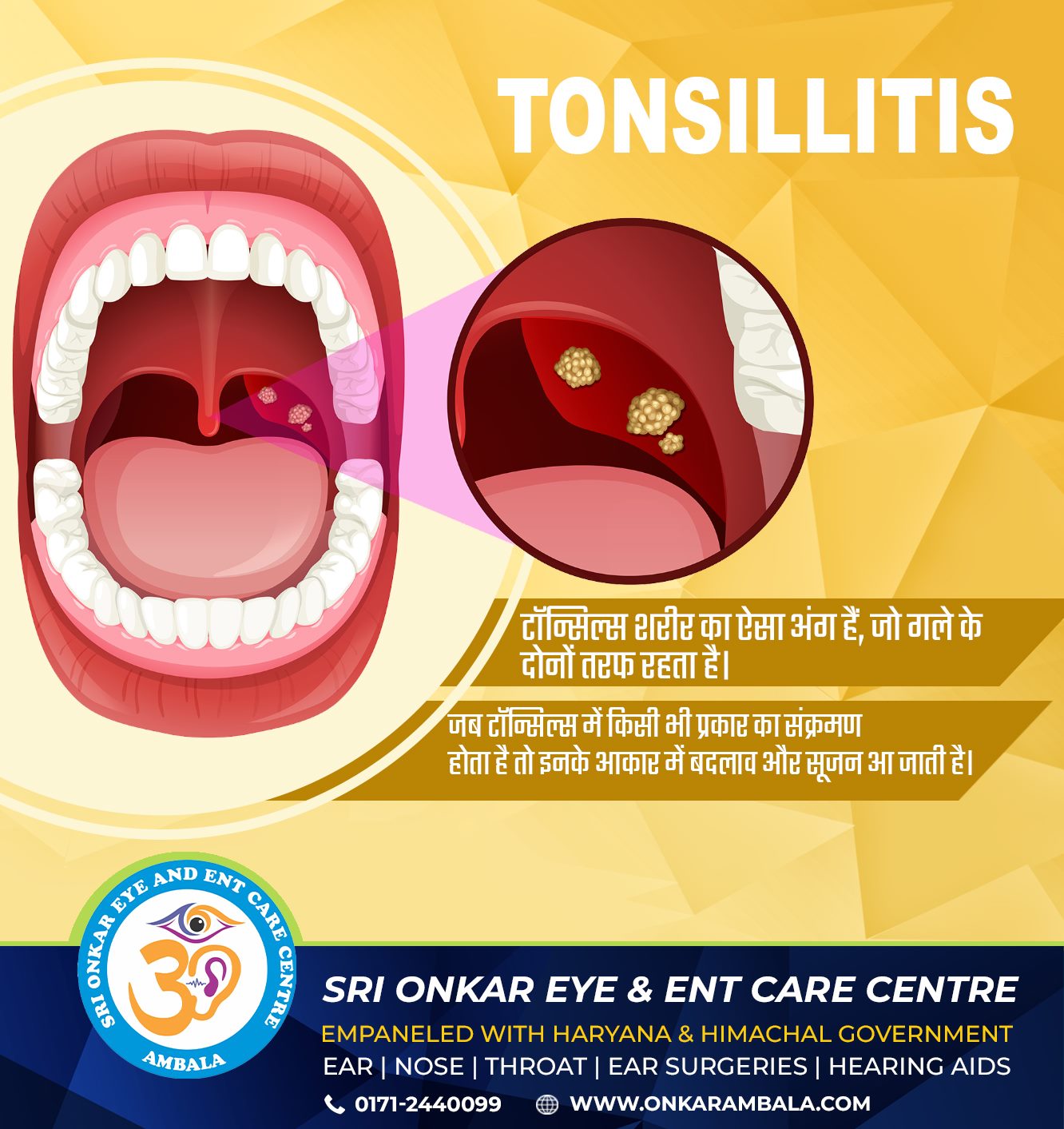 Tonsil Infection Treatment in Ambala | Sri Onkar Eye & ENT Care Centre