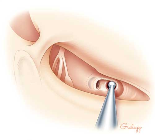 Cochleostomy